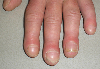 Verrassend Trommelstokvingers door longtumor | medischcontact CP-77