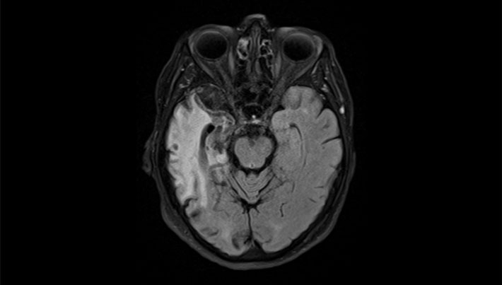 MRI van de hersenen zes maanden later. Uitgebreid weefselverlies rechts temporaal van de hippocampus en insulair rechts met uitgebreide gliose.