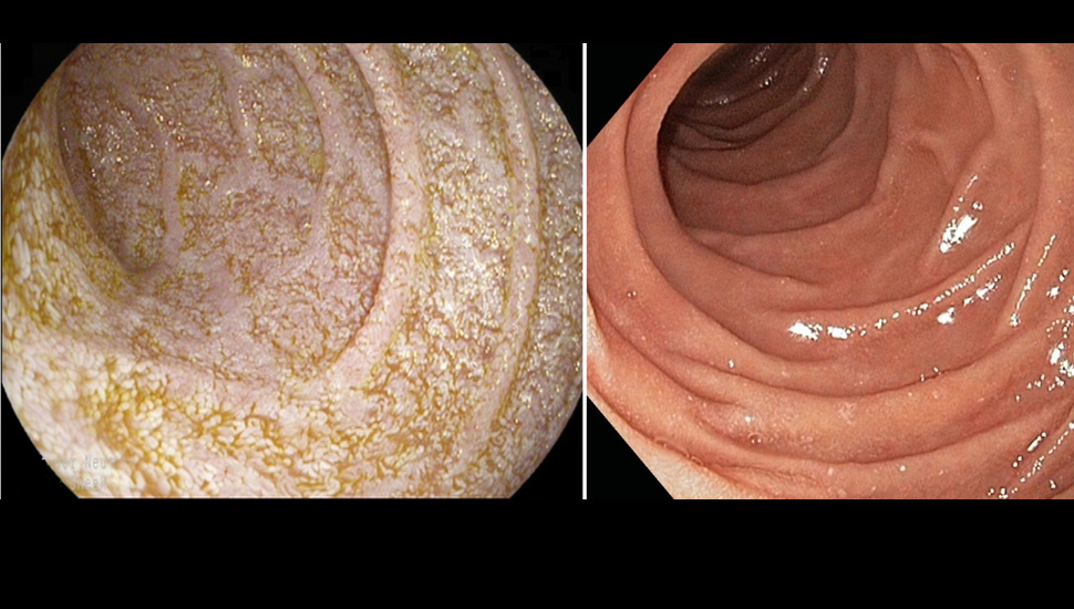 Endoscopische weergave van het ­duo­denum bij gastroduonescopie. Links: Bij onze patiënt was sprake van bleke en grove villi met daarbij een erythemateus en ulceratief mucosabeeld. Rechts: Normaal duodenum.   