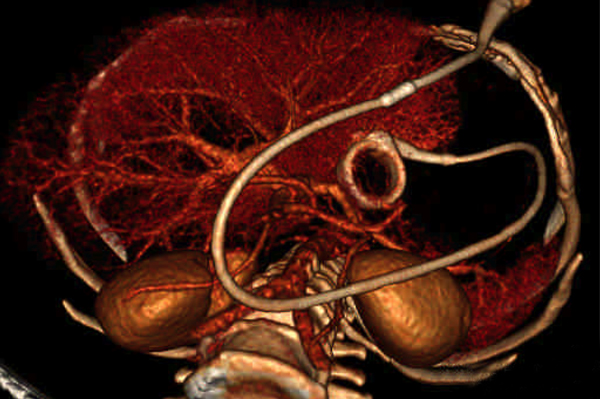 De CT-scan laat zien dat de tube van de maagband tot aan de radix mesenterii om het dunnedarmpakket heen is gelegen.