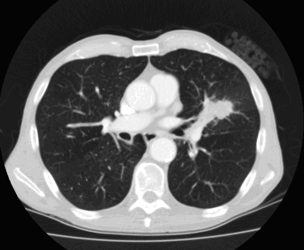 De CT-scan toont niet alleen een tumor in de long, maar ook de vermoedelijke oorzaak: langdurig roken.