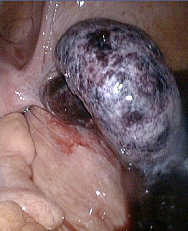 Laparoscopisch beeld, getordeerd cysteus vergroot adnex rechts. 