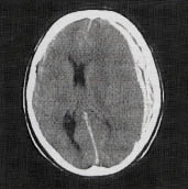 A. Deze scan laat een subduraal hematoom zien. Bij scheuring van de venen die op het oppervlak van de hersenen lopen, ontstaat een veneuze bloeding. Patiënten komen vaak al comateus binnen, doordat 80 procent van hen ook een flinke hersenschudding heeft.