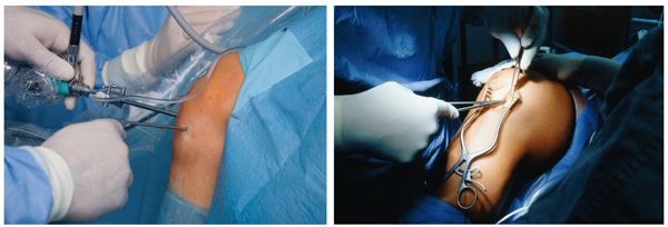 Een operatie van de knie kan endoscopisch gebeuren, maar het kan ook een open operatie zijn. De kosten daarvan kunnen verschillen, maar in de geregistreerde data zie je dat verschil niet terug. Beeld: iStockphoto/Corbis