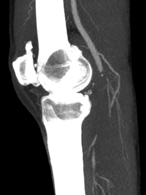 3. CT-angiografie met afsluiting a. poplitea ter hoogte van gewrichtsspleet.