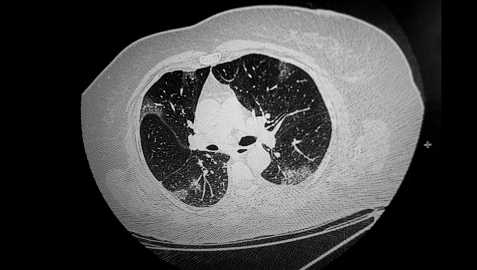 CT van longen geïnfecteerd met coronavirus.  © Michael Bunel/Le Pictorium Agency via ZUMA Press