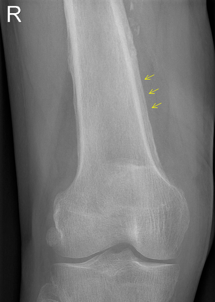 Op de röntgenopnames van de knieën is een verdikking van de cortex te zien van vooral de distale femora.