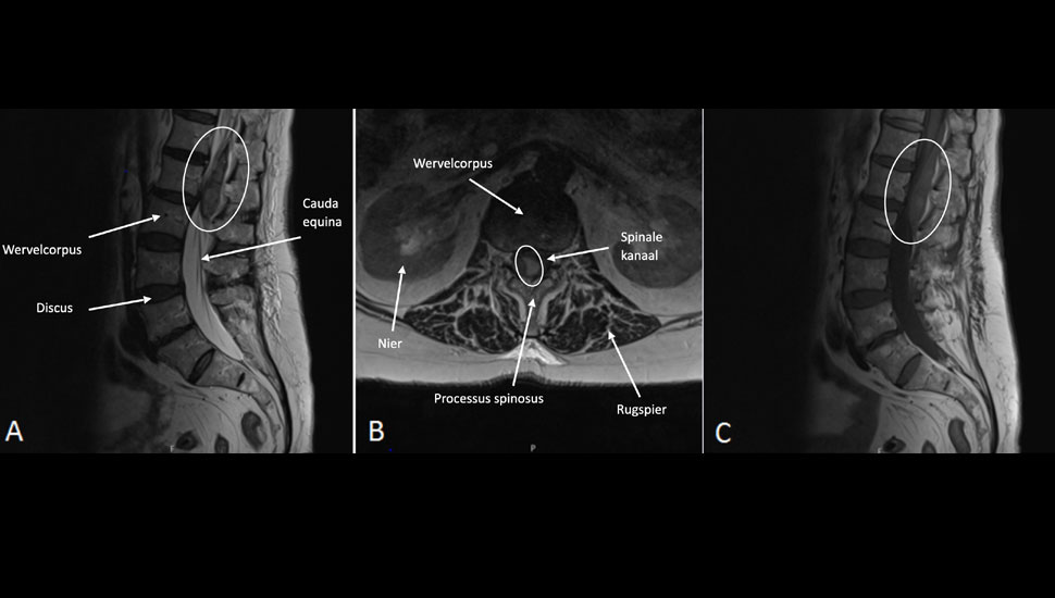 Beeld auteurs. Midline sagittale (A) en L1-L2 axiale (B) T2 gewogen MRI-opname en midline sagittale (C) T1 gewogen MRI-opname zonder contrast van de lumbale wervelkolom.  Posterieure collectie binnen de epidurale ruimte van niveau Th12 tot L2, iso-intens op T1- en heterogeen op T2-opnames wat overeenkomt met een acuut stadium spinaal epiduraal hematoom.   