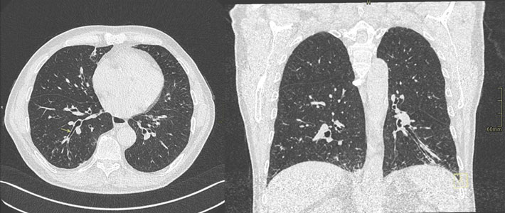 CT-thorax vertoont beiderzijds bronchiëctasieën met mucusplugging, matglasconsolidaties en ‘tree-in-bud’-verdichtingen.