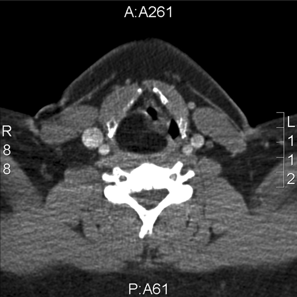 Op de CT is een zwelling te zien van 2 bij 3 cm in de hypofarynx.