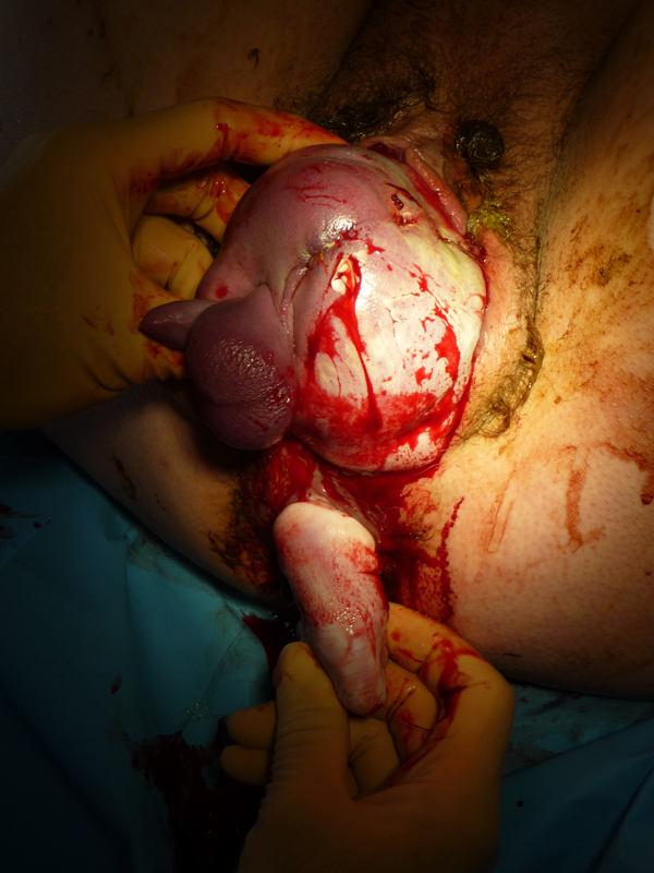 De linkervoet en een deel van het linkerbeen van de baby door het septum rectovaginale en de anus geboren. beeld: auteurs
