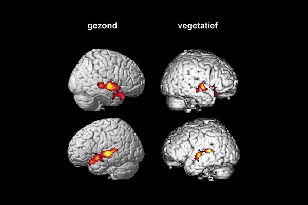 Bij het horen van spraak vertonen de hersenen van bepaalde mensen in een vegetatieve toestand activiteit die vergelijkbaar is met die van de hersenen van gezonde mensen. beeld: Adrian Mark Owen