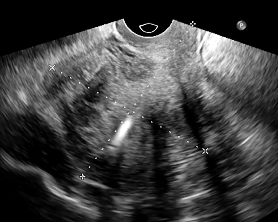 sagittale doorsnede van de uterus