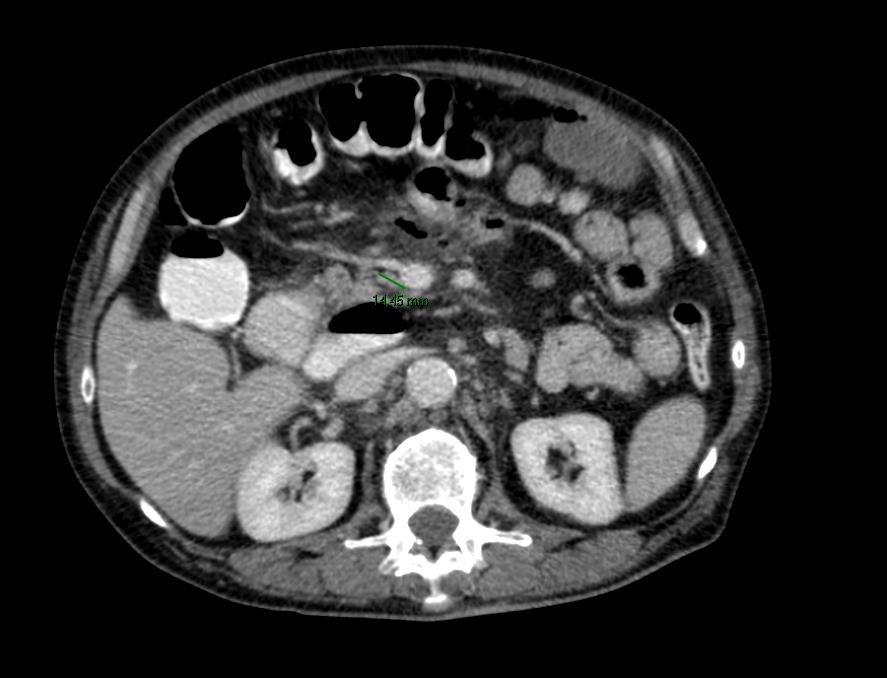 Reactieve induratie van het omliggende vetweefsel met lymfadenopathie op CT-scan.