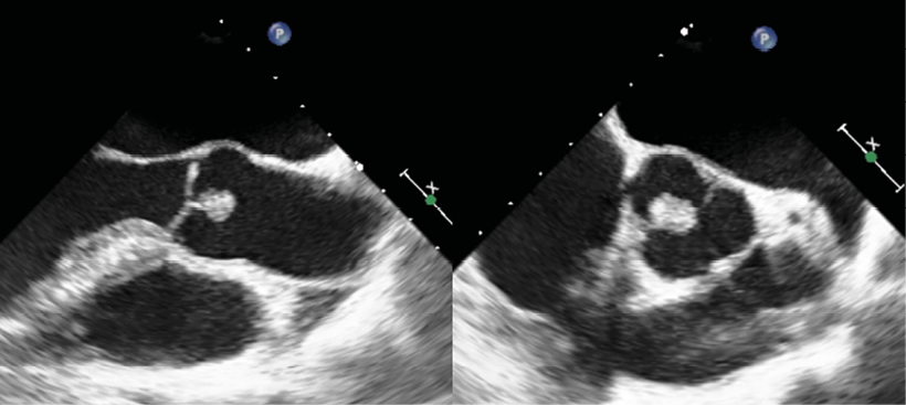 1. TEE-opname, met doorsnede van de aortaklep in lange as (links) en korte as (rechts) met de bolvormige structuur aan de non-coronaire cusp.