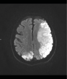 Figuur 2 en 3. MRI toont uitgebreide diffusierestrictie ten teken van multipele infarceringen, onder andere in de linkerhemisfeer, occipitaalkwabben en thalami, en meerdere puntvormige corticale en subcorticale infarcten in de rechterhemisfeer (sterrenhemelpatroon).