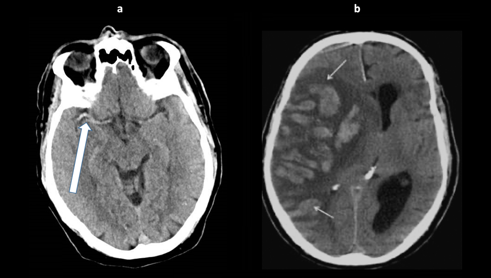 Foto 1. CT-scan na herseninfarct (2005). Dense middle cerebral artery sign (a, pijl) en hemorragische transformatie twee dagen later bij de patiënte met een acuut herseninfarct in de rechter cerebrale hemisfeer (b).
