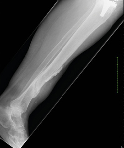 1. Laterale röntgenopname van het linkeronderbeen met een insufficiëntiefractuur van de tibia met callus formatie. Op een derde hoogte van het onderbeen anterieur is een pre-existente weke-delencalcificatie te zien. beeld auteurs