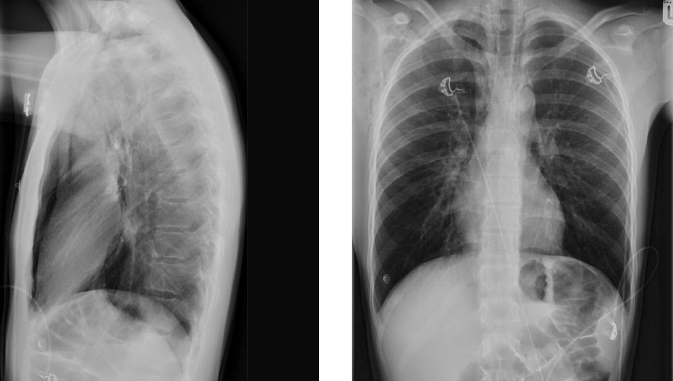 X-thorax: AP-opname. Subcutaan emfyseem waarneembaar in rechteraxilla en in de halsregio. en X-thorax: laterale opname. Precordiaal lucht in mediastinum.