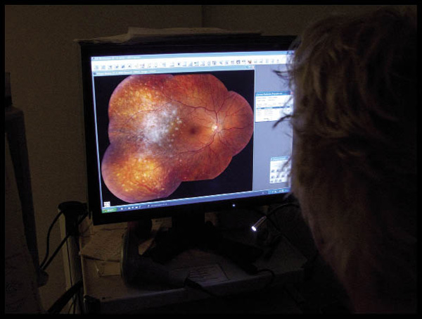 Op de oogafdeling wordt naar de kankerschade van het netvlies gekeken. De witte vlekjes zijn het resultaat van een met MTX behandeld ooglymfoom.