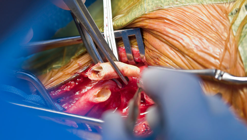 Getty Images. Chirurgische verwijdering van carotisstenose door middel van een carotisendarteriëctomie (CEA).