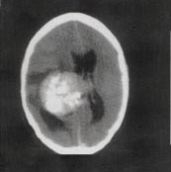 D. Deze scan laat een groot meningeoom uitgaand van de hersenbalk zien. De hyperdense (witte) gebieden zijn verkalkingen in de tumor.