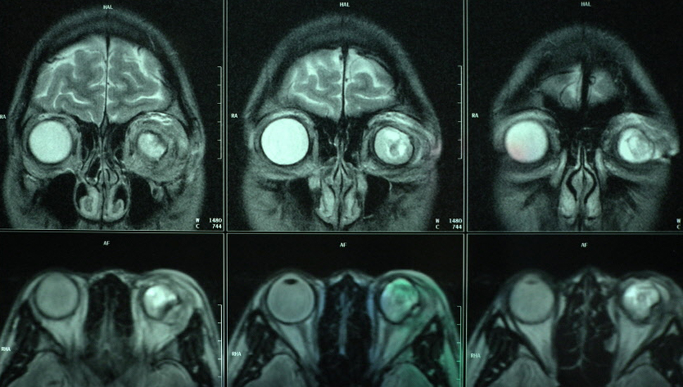 MRI-scan van oogletsel ten gevolge van vuurwerk. Fotografie: Eric Brinkhorst / Hollandse Hoogte