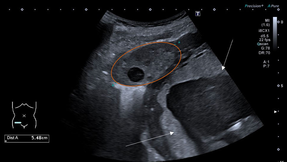 De rechteradnex (oranje omcirkeld) zichtbaar rechtsonder in de buik, ventraal van de uterus (witte pijlen). De maximale lengte van de adnex betrof 5,5 mm.   