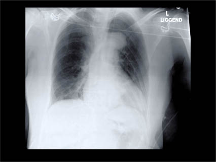 Foto 2. X-thorax postoperatief.