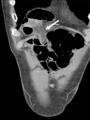 Foto 3.De CT-scan toont dat ook het mesenterium is gestuwd (pijl). Dit wijst op een beklemde hernia van Morgagni.