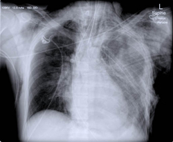 De thoraxfoto toont subcutaan emfyseem, endotracheale tube, thoraxdrain en pneumopericardium (‘halo-sign’). 