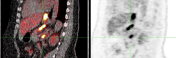 1. Sagittale PET-CT-opname bij patiënt A. Pathologische FDG-stapeling in een lymfeklier op het niveau van arteria mesenterica superior (groene markering). 