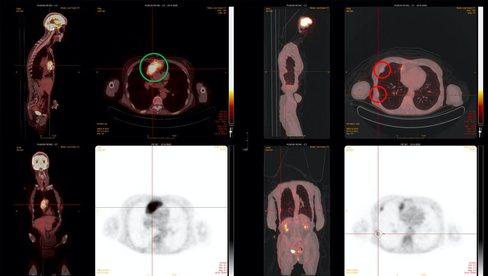 Beeld auteurs. PET-CT met een fors FDG-stapelend proces, waarschijnlijk uitgaande van het voorste mediastinum (groene cirkel), en rechts pleuraal meerdere redelijk actieve laesies (rode cirkels). 