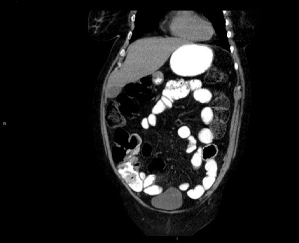 1. CT-abdomen met verdikt vetweefsel rond de appendix