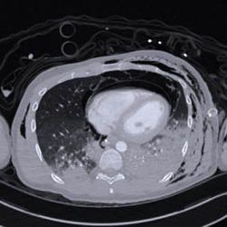CT-scan met subcutaan emfyseem, hemopneumothorax en pneumopericardium.