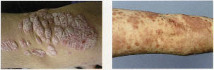 (uit Praktische dermatologie): Op predilectieplaatsen voor psoriasis vulgaris ontstaan rode plaques.