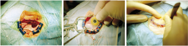 Eerst wordt een gaatje in de schedel gemaakt (links). Daardoor kan het inwendige deel van het implantaat worden geplaatst (midden). Beeld:Laif, HH