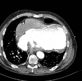 2 Transversale afbeelding van een CT-onderzoek van de thorax, na intraveneuze contrasttoediening. Er is een groot aneurysma (12,5 cm) van de linkerventrikel met uitgebreide wandstandige lineaire calcificaties.