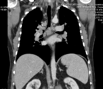 CT thorax abdomen: lymfadenopathie media-stinaal en hilair beiderzijds alsmede lichte hepatosplenomegalie; geen focale afwijkingen in de lever en milt.