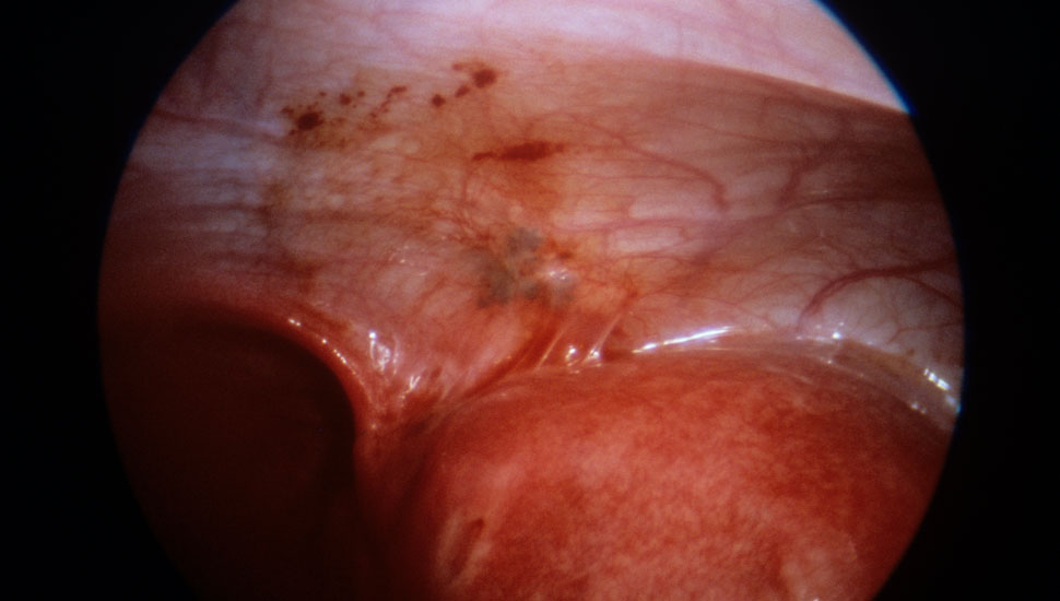 Laparoscopisch beeld van peritoneale endometriose (de donkere vlekken bovenin). - Science Photo Library / ANP
