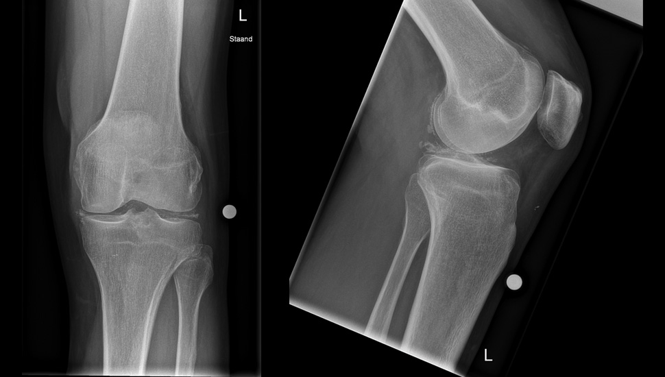Foto 1 en 2: chondrocalcinose met verkalkingen van kraakbeen en menisci. Verkalking van kraakbeen is met name posterieur te zien op de laterale foto ter hoogte van het femur.   
