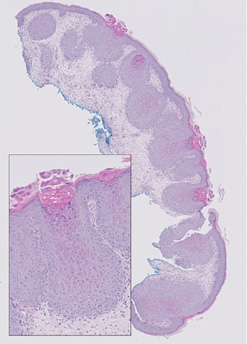 Foto 2: Histologisch onderzoek van een papel toont intracytoplasmatische eosinofiele inclusies met viruspartikels in keratincoyten van het stratum spinosum en stratum granulosum (vergroting 20 keer met uitvergroting 100 keer).