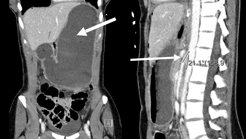 1 CT-abdomen (portoveneuze fase), zeer fors gedilateerde maag (pijl) met neusmaagsonde in situ (links). 3 Herbeoordeling CT-abdomen: beeld en metingen van de aortomesenteriale hoek (21°) (pijl) passend bij het syndroom van Wilkie (rechts).   