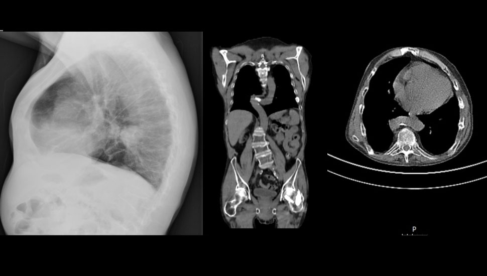 Links: Laterale X-thorax met een dense massa ventraal van de thoracale wervelkolom | Midden: FDG PET/CT in axiale richting: het oversteken van de aorta ventraal van de thoracale wervelkolom | Rechts: FDG PET/CT in coronale richting: extreme tortuositeit van de descenderende aorta