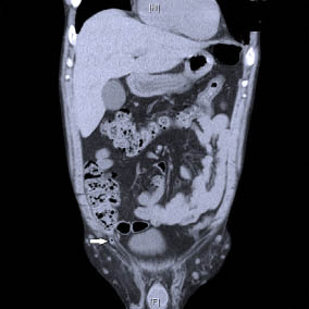 Proximaal deel appendix zichtbaar onder aan caecum