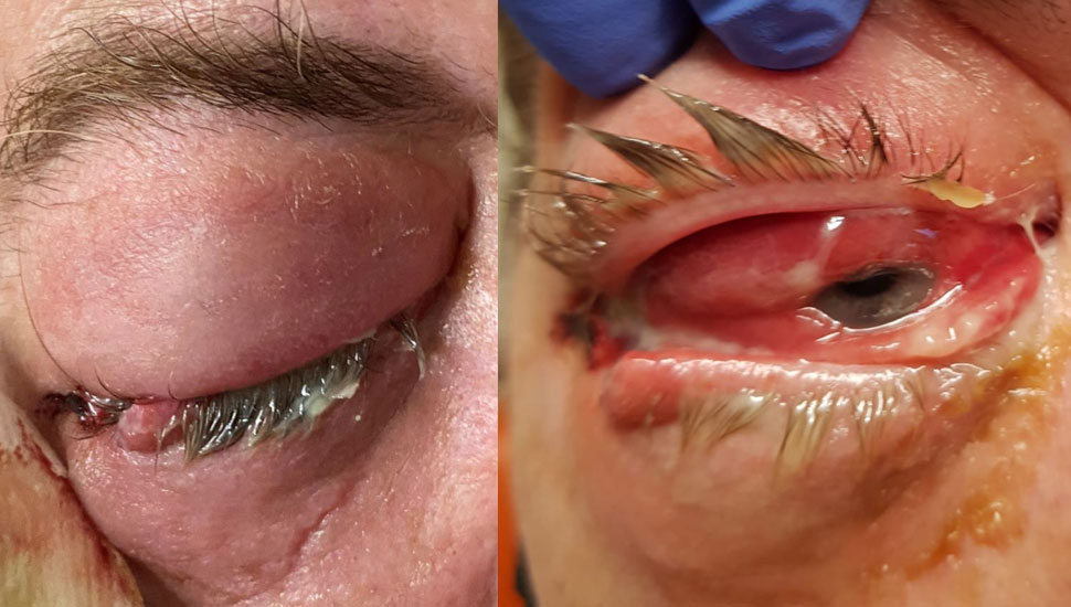 Foto 1 (links): Erythemateus, gezwollen ooglid met pusuitvloed | Foto 2 (rechts): Chemosis, proptosis