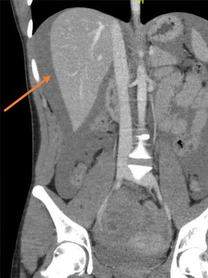 CT-abdomen met intraveneus contrast toont veel homogeen vocht (waarschijnlijk bloed) diffuus door de buik. Bij de oranje pijl onder andere vrij vocht rondom de lever te zien. Ten tijde van de scan was het hCG nog niet bekend en werd vooral gedacht aan een extra-uteriene graviditeit of een andere gynaecologische oorzaak.   