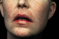 Close up van de pijnlijke mondklachten veroorzaakt door de chemo.
