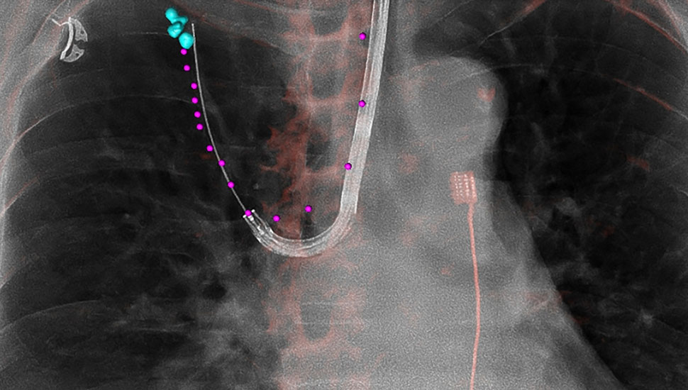 Foto 3: Klinisch voorbeeld van de 3D-registratie en beeldvorming op de hybride ok om verdachte afwijkingen in de longen via flexibele instrumenten en de natuurlijke luchtwegen te bereiken. Door de 3D-beeldvorming kunnen de flexibele instrumenten naar de afwijking genavigeerd worden, om vervolgens weefsel af te nemen voor het verkrijgen van een diagnose.