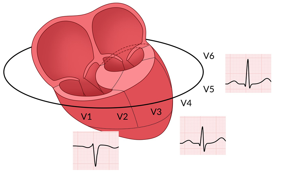Een schematische weergave van het hart. De atria zijn aan de voorzijde afgesneden. Dit biedt een eenvoudig inwendig anatomisch overzicht. Dit overzicht beperkt zich tot het relevante: het fenomeen van ‘R-topprogressie’ begrijpen. 